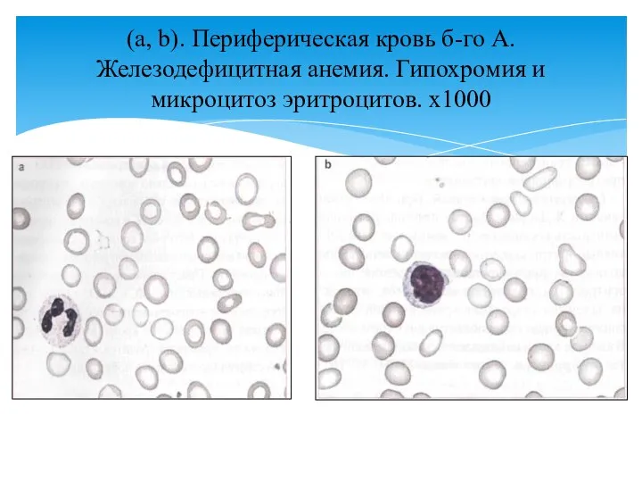 (a, b). Периферическая кровь б-го А. Железодефицитная анемия. Гипохромия и микроцитоз эритроцитов. х1000