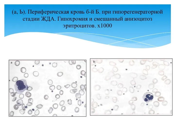 (а, Ь). Периферическая кровь б-й Б. при гипорегенераторной стадии ЖДА. Гипохромия и смешанный анизоцитоз эритроцитов. х1000