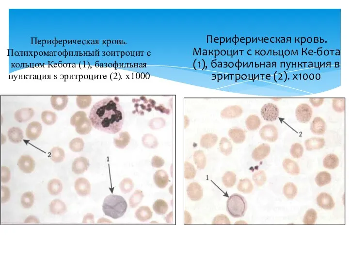 Периферическая кровь. Полихроматофильный зоитроцит с кольцом Кебота (1), базофильная пунктация s