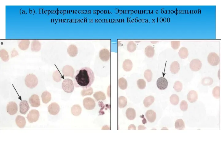 (a, b). Периферическая кровь. Эритроциты с базофильной пунктацией и кольцами Кебота. х1000