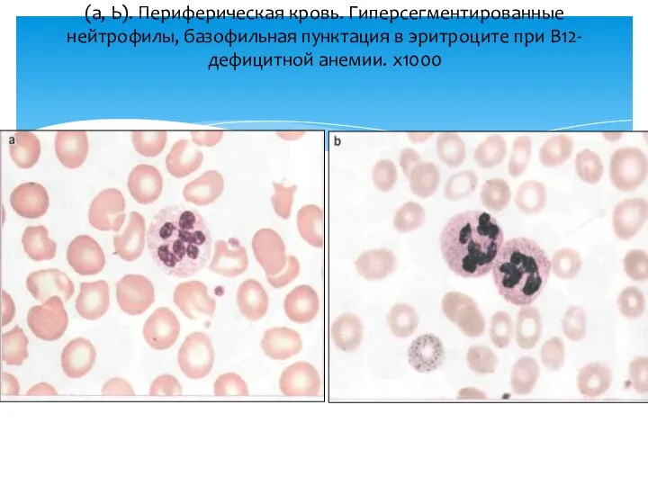 (а, Ь). Периферическая кровь. Гиперсегментированные нейтрофилы, базофильная пунктация в эритроците при В12-дефицитной анемии. х1000