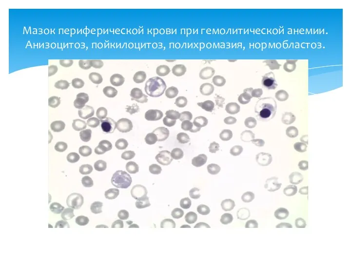 Мазок периферической крови при гемолитической анемии. Анизоцитоз, пойкилоцитоз, полихромазия, нормобластоз.