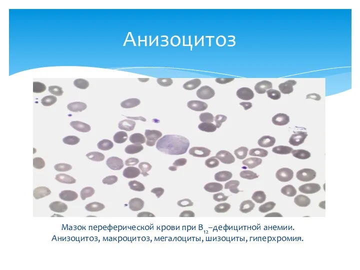 Мазок переферической крови при В12–дефицитной анемии. Анизоцитоз, макроцитоз, мегалоциты, шизоциты, гиперхромия. Анизоцитоз