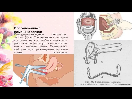 Исследование с помощью зеркал Самоудерживающееся створчатое зеркало (Куско, Трела) вводят в