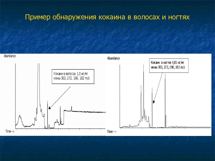 Пример обнаружения кокаина в волосах и ногтях