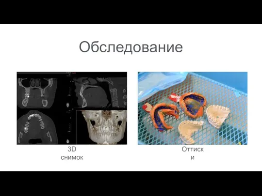 Обследование 3D снимок Оттиски