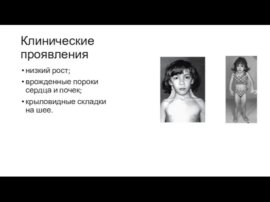 Клинические проявления низкий рост; врожденные пороки сердца и почек; крыловидные складки на шее.