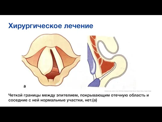 Хирургическое лечение Четкой границы между эпителием, покрывающим отечную область и соседние