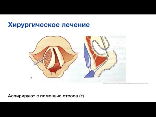 Хирургическое лечение Аспирируют с помощью отсоса (г) Болезни уха, горла и