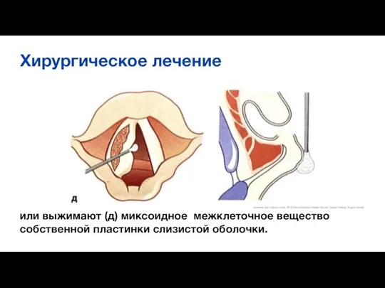 Хирургическое лечение или выжимают (д) миксоидное межклеточное вещество собственной пластинки слизистой