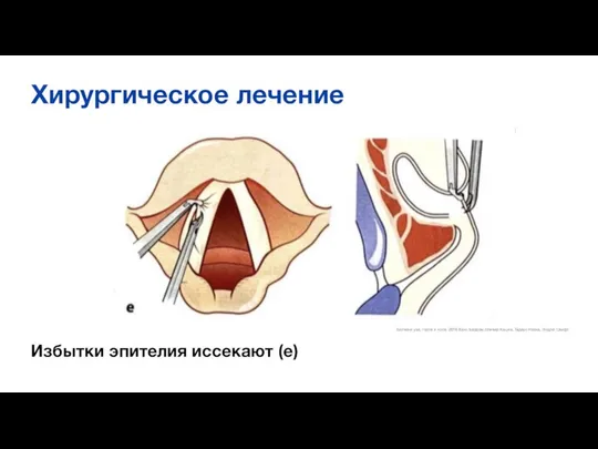 Хирургическое лечение Избытки эпителия иссекают (е) Болезни уха, горла и носа.