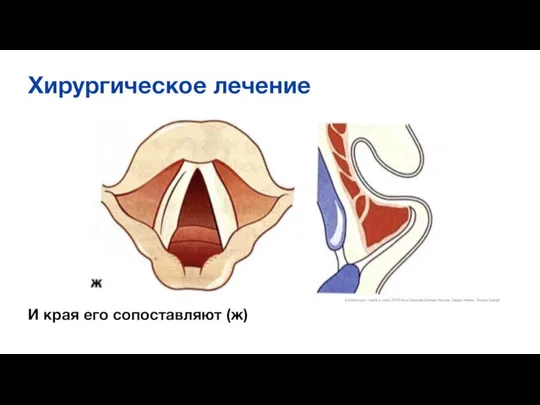 Хирургическое лечение И края его сопоставляют (ж) Болезни уха, горла и