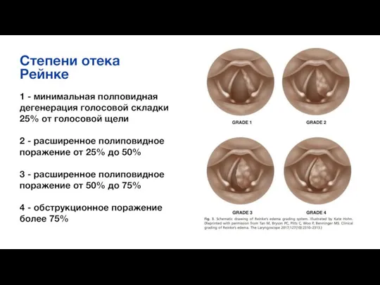 Степени отека Рейнке 1 - минимальная полповидная дегенерация голосовой складки 25%