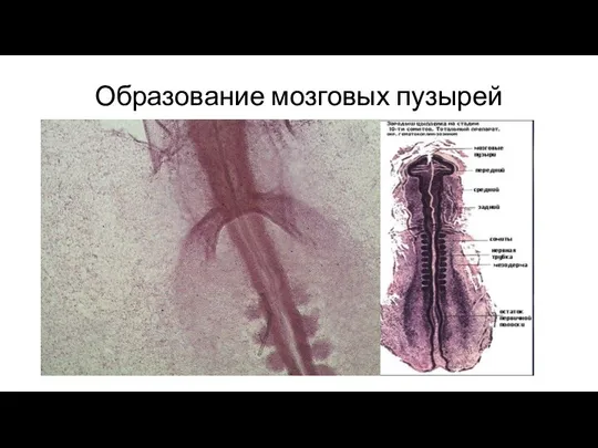 Образование мозговых пузырей