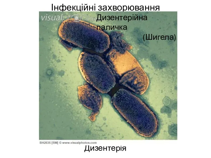 Інфекційні захворювання Дизентерія Дизентерійна паличка (Шигела)