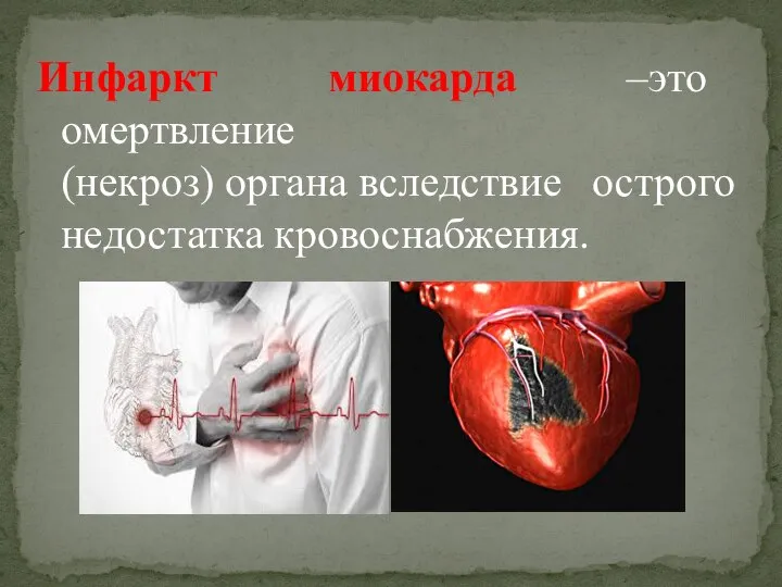 Инфаркт миокарда –это омертвление (некроз) органа вследствие острого недостатка кровоснабжения.