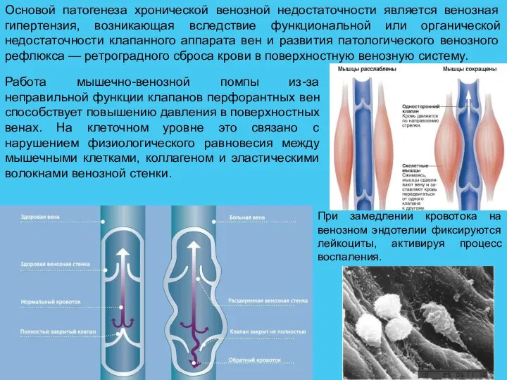 Основой патогенеза хронической венозной недостаточности является венозная гипертензия, возникающая вследствие функциональной