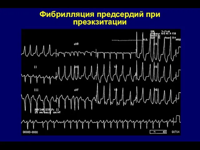 Фибрилляция предсердий при преэкзитации