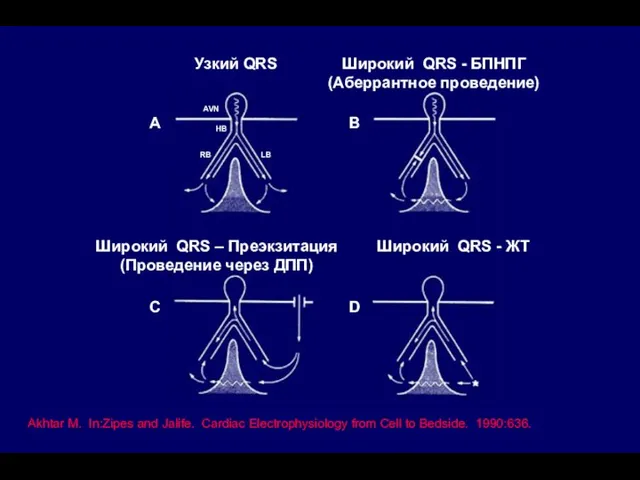 Akhtar M. In:Zipes and Jalife. Cardiac Electrophysiology from Cell to Bedside.