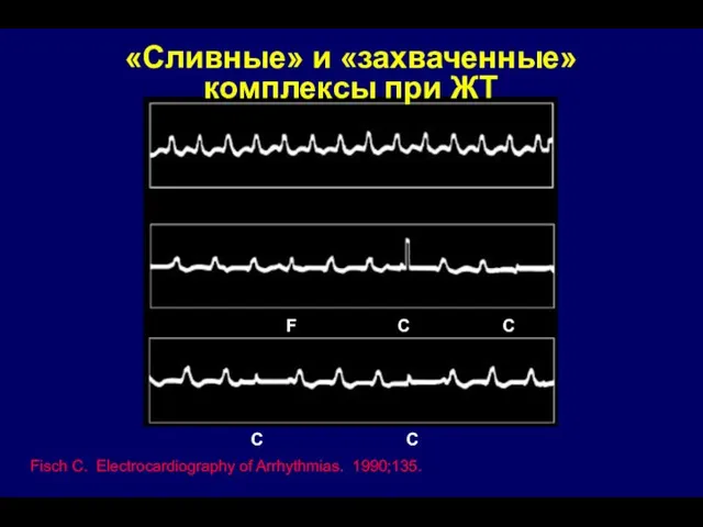 «Сливные» и «захваченные» комплексы при ЖТ Fisch C. Electrocardiography of Arrhythmias.