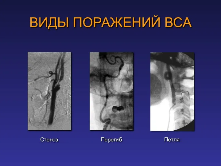 Стеноз Петля Перегиб ВИДЫ ПОРАЖЕНИЙ ВСА