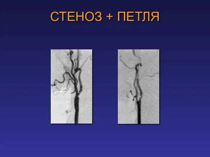 СТЕНОЗ + ПЕТЛЯ