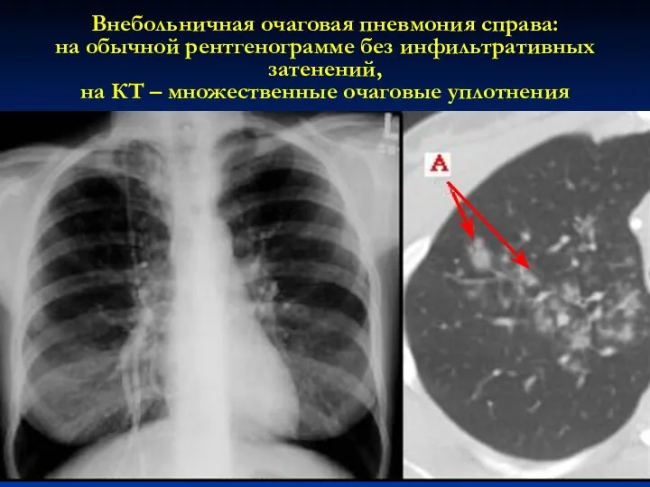 Внебольничная очаговая пневмония справа: на обычной рентгенограмме без инфильтративных затенений, на КТ – множественные очаговые уплотнения