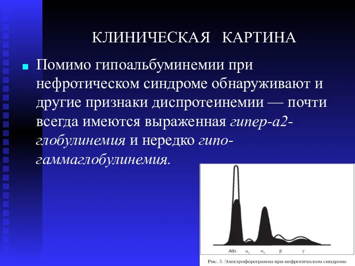 КЛИНИЧЕСКАЯ КАРТИНА Помимо гипоальбуминемии при нефротическом синдроме обнаруживают и другие признаки