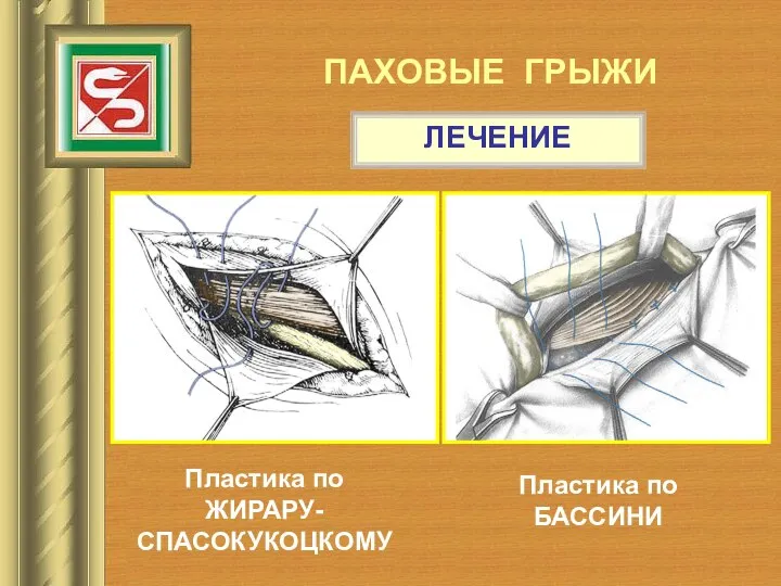 ПАХОВЫЕ ГРЫЖИ ЛЕЧЕНИЕ Пластика по ЖИРАРУ-СПАСОКУКОЦКОМУ Пластика по БАССИНИ