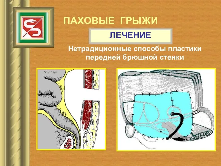 ПАХОВЫЕ ГРЫЖИ ЛЕЧЕНИЕ Нетрадиционные способы пластики передней брюшной стенки