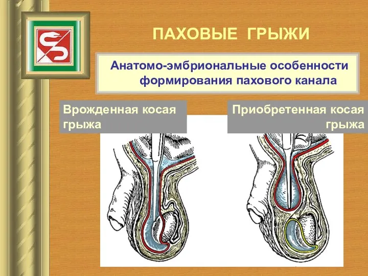 ПАХОВЫЕ ГРЫЖИ Анатомо-эмбриональные особенности формирования пахового канала Врожденная косая грыжа Приобретенная косая грыжа