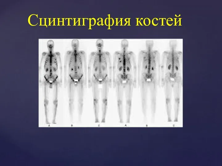 Сцинтиграфия костей