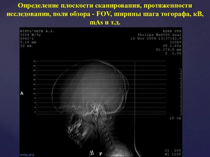 Определение плоскости сканирования, протяженности исследования, поля обзора - FOV, ширины шага тогорафа, кВ, mAs и т.д.