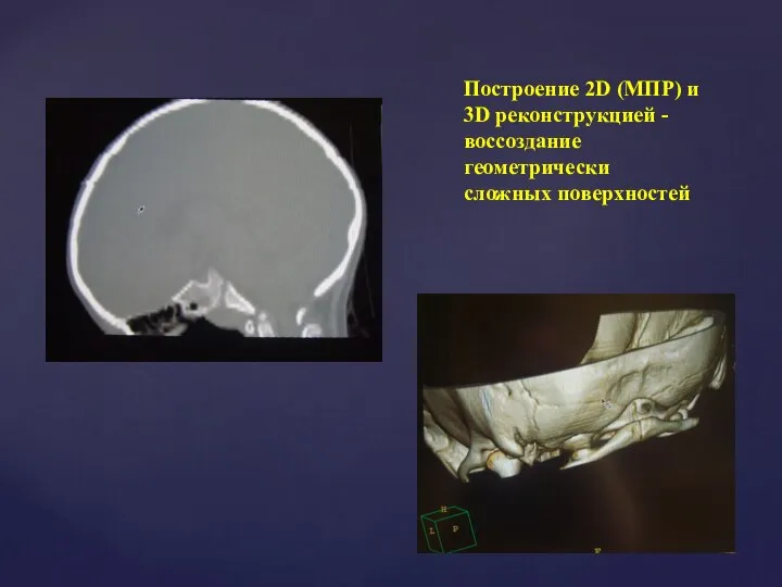 Построение 2D (МПР) и 3D реконструкцией - воссоздание геометрически сложных поверхностей