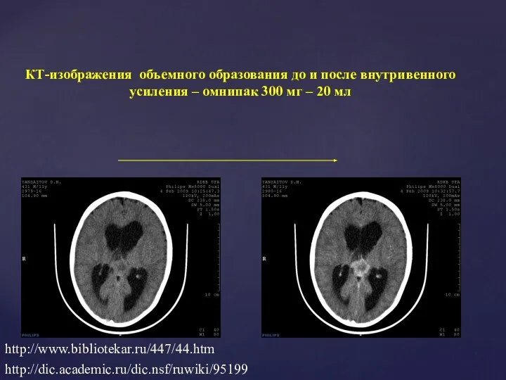 КТ-изображения объемного образования до и после внутривенного усиления – омнипак 300