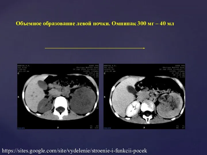 Объемное образование левой почки. Омнипак 300 мг – 40 мл https://sites.google.com/site/vydelenie/stroenie-i-funkcii-pocek