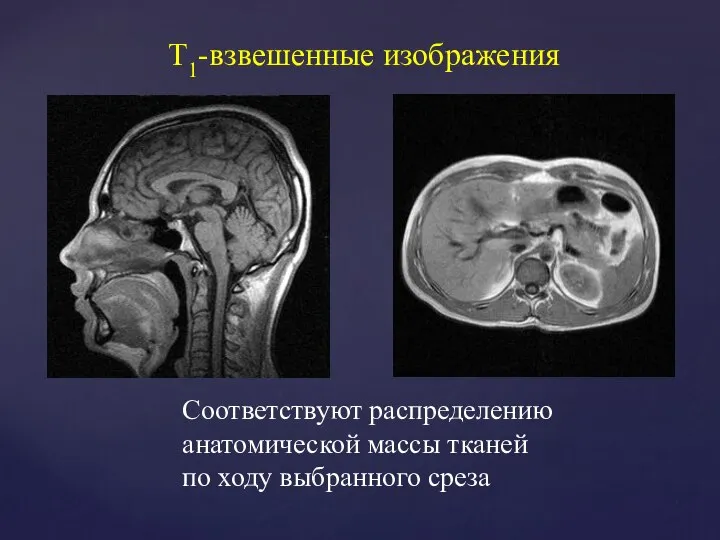 Т1-взвешенные изображения Соответствуют распределению анатомической массы тканей по ходу выбранного среза