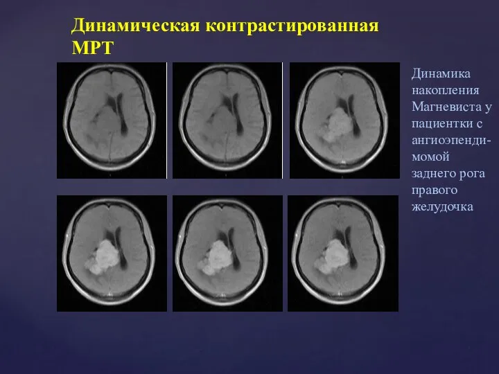 Динамическая контрастированная МРТ Динамика накопления Магневиста у пациентки с ангиоэпенди-момой заднего рога правого желудочка