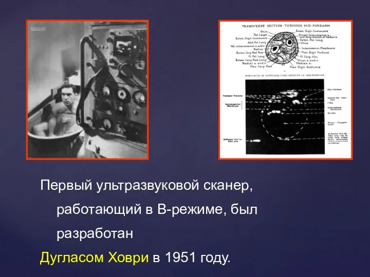 Первый ультразвуковой сканер, работающий в В-режиме, был разработан Дугласом Ховри в 1951 году.