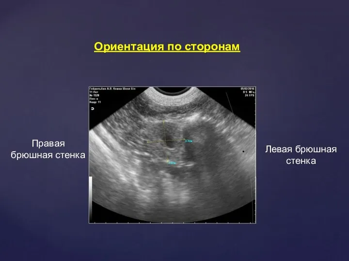 Ориентация по сторонам Правая брюшная стенка Левая брюшная стенка