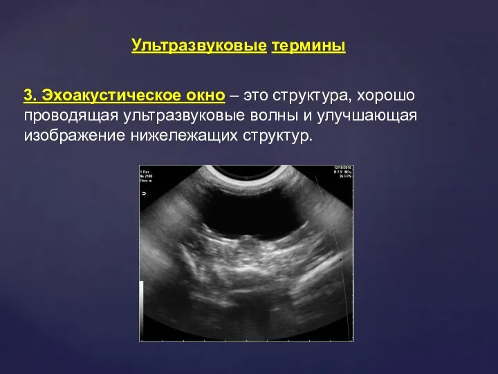 3. Эхоакустическое окно – это структура, хорошо проводящая ультразвуковые волны и