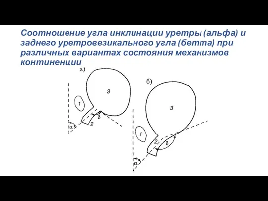 Соотношение угла инклинации уретры (альфа) и заднего уретровезикального угла (бетта) при различных вариантах состояния механизмов континенции