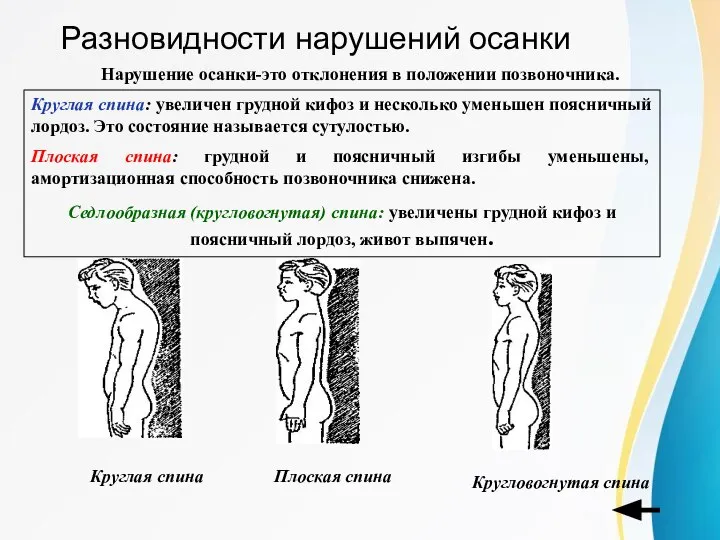 Разновидности нарушений осанки Нарушение осанки-это отклонения в положении позвоночника. Круглая спина: