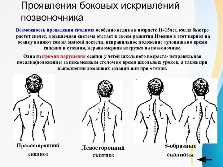 Проявления боковых искривлений позвоночника Возможность проявления сколиоза особенно велика в возрасте