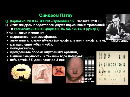 Синдром Патау Кариотип 2n = 47, ХХ+13 – трисомия 13; Частота