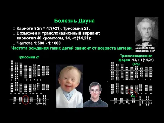 Болезнь Дауна Джон Лэнгдон Даун (1828-1896) английский врач  Кариотип 2n