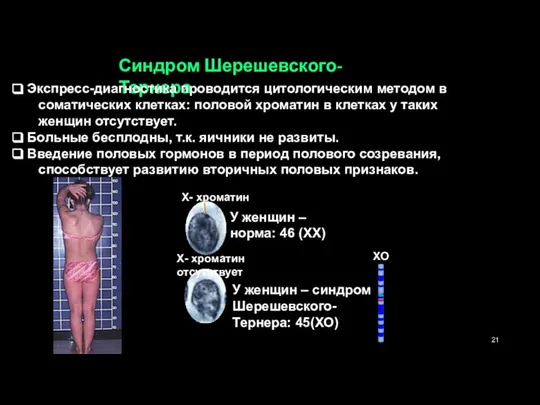 Синдром Шерешевского-Тернера Экспресс-диагностика проводится цитологическим методом в соматических клетках: половой хроматин