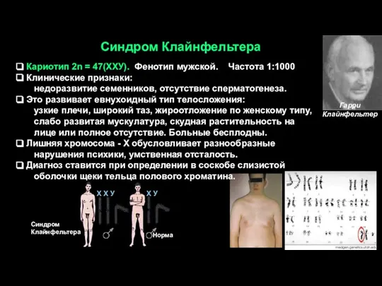 Синдром Клайнфельтера Кариотип 2n = 47(ХХУ). Фенотип мужской. Частота 1:1000 Клинические