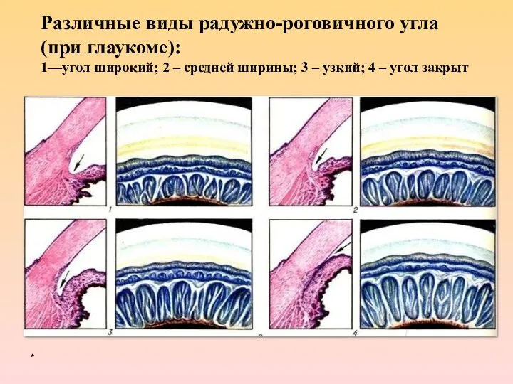 * Различные виды радужно-роговичного угла (при глаукоме): 1—угол широкий; 2 –