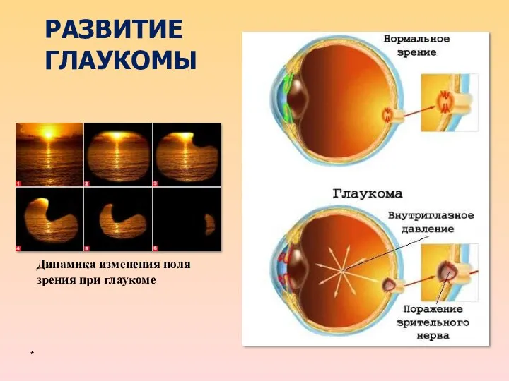 РАЗВИТИЕ ГЛАУКОМЫ * Динамика изменения поля зрения при глаукоме